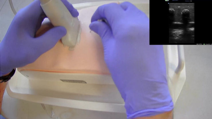 MiniSim Paravertebral Ultrasound Block